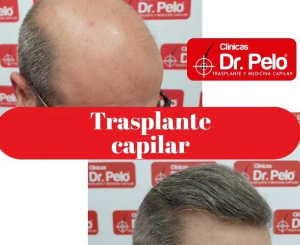 capilar